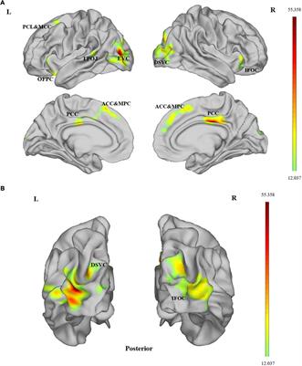 Surface-Based Amplitude of Low-Frequency Fluctuation Alterations in Patients With Tinnitus Before and After Sound Therapy: A Resting-State Functional Magnetic Resonance Imaging Study
